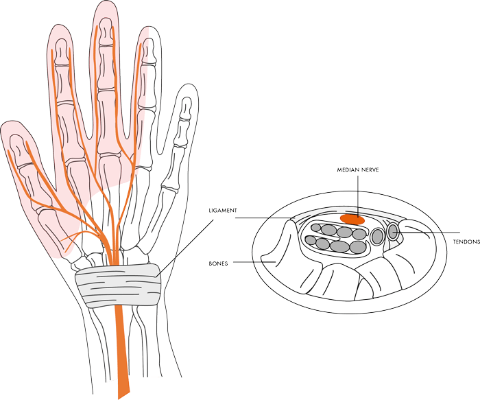 Carpal Tunnel Syndrome 1 carpaltunnelsyndrome img1 - Dr Cameron Mackay