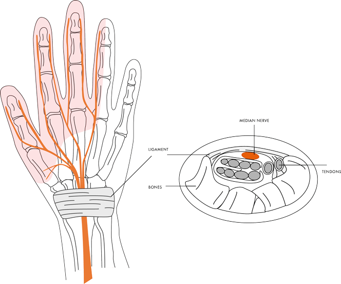 carpaltunnelsyndrome img1 - Dr Cameron Mackay