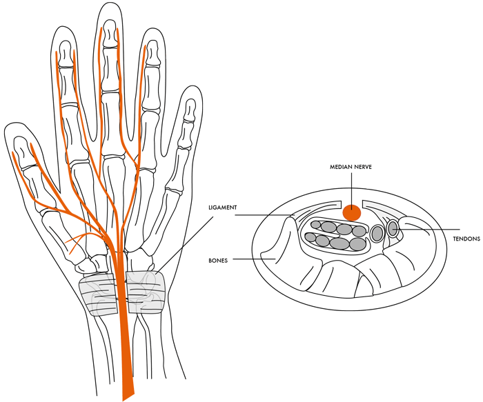 Carpal Tunnel Syndrome 2 carpaltunnelsyndrome img2 - Dr Cameron Mackay