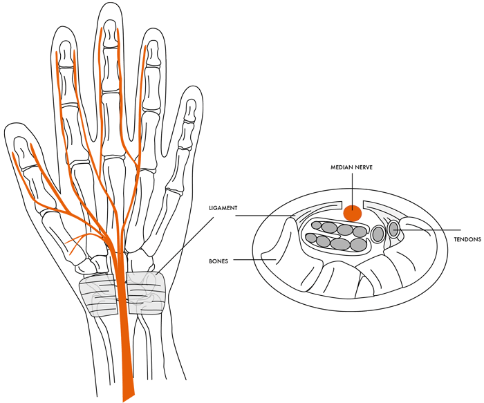 carpaltunnelsyndrome img2 - Dr Cameron Mackay