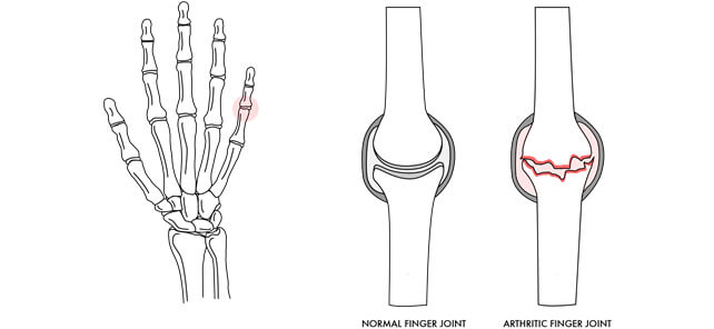 arthritis img1 - Dr Cameron Mackay