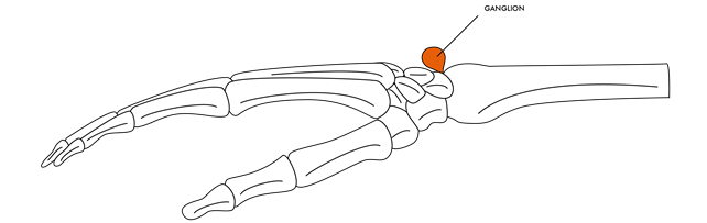 ganglions img1 - Dr Cameron Mackay