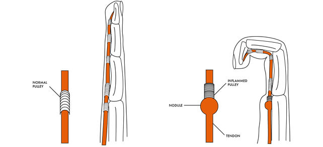 Trigger Finger 1 triggerfinger img1 - Dr Cameron Mackay